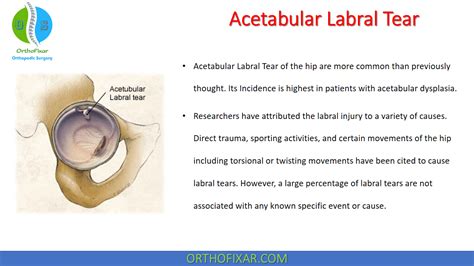 acetabular labral tear special tests accuracy trial|acetabular labral tear management.